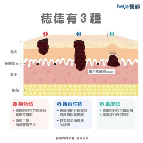 為什麼痣會長毛|痣變大、痣多或長毛會變皮膚癌？認識痣的形成與原因